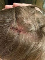 L’impact contre le mur du corridor a fendu la tête de l’individu.