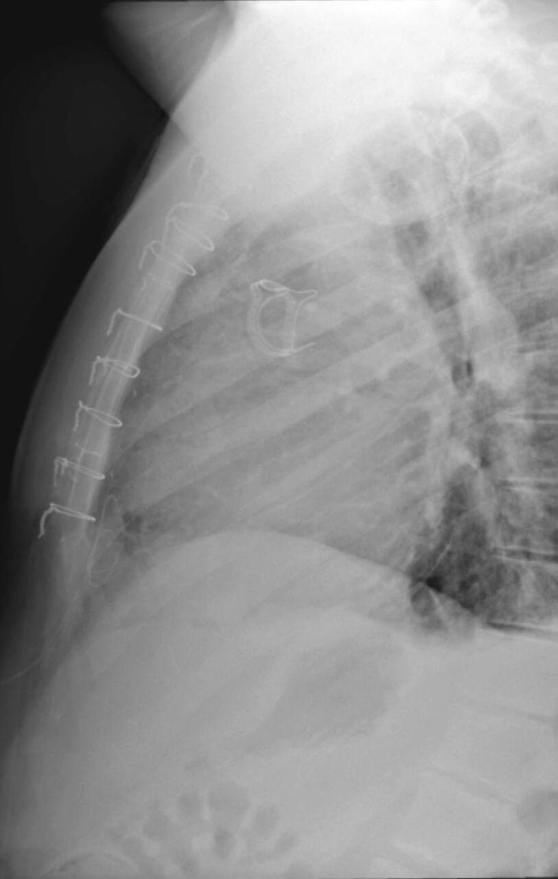 On peut apercevoir les broches métalliques sur mon sternum et la valve porcine située dans mon cœur sur une radiographie postopératoire.
