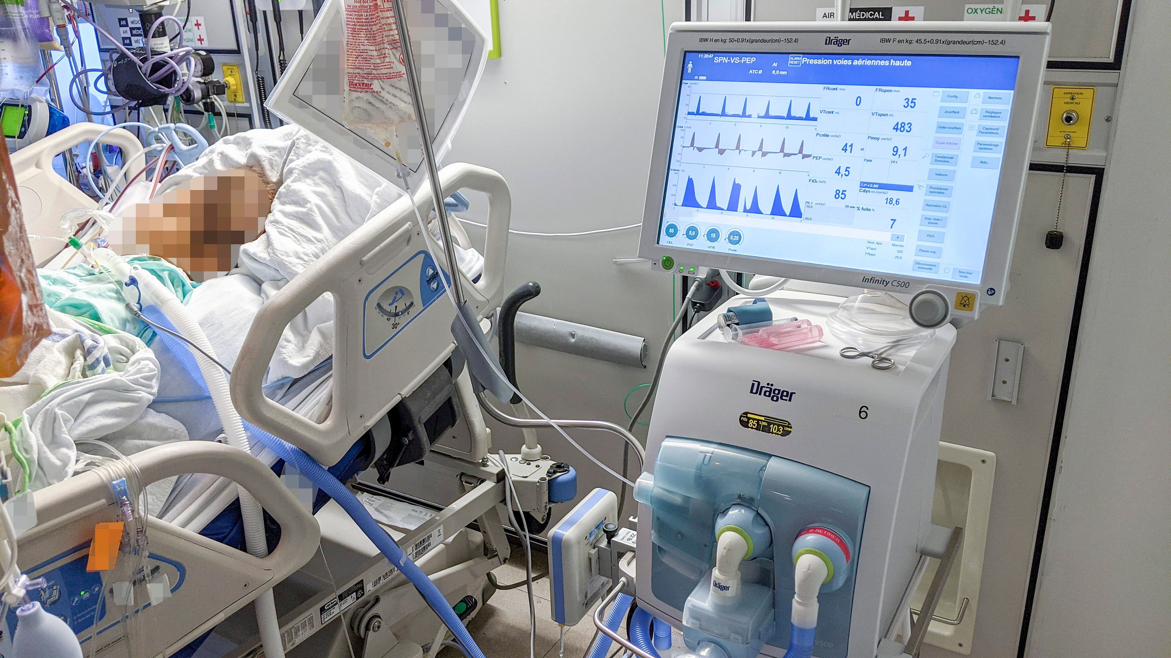Une personne atteinte de la COVID-19 intubée à un ventilateur médical, dans le service des soins intensifs d'un hôpital de la région montréalaise.
