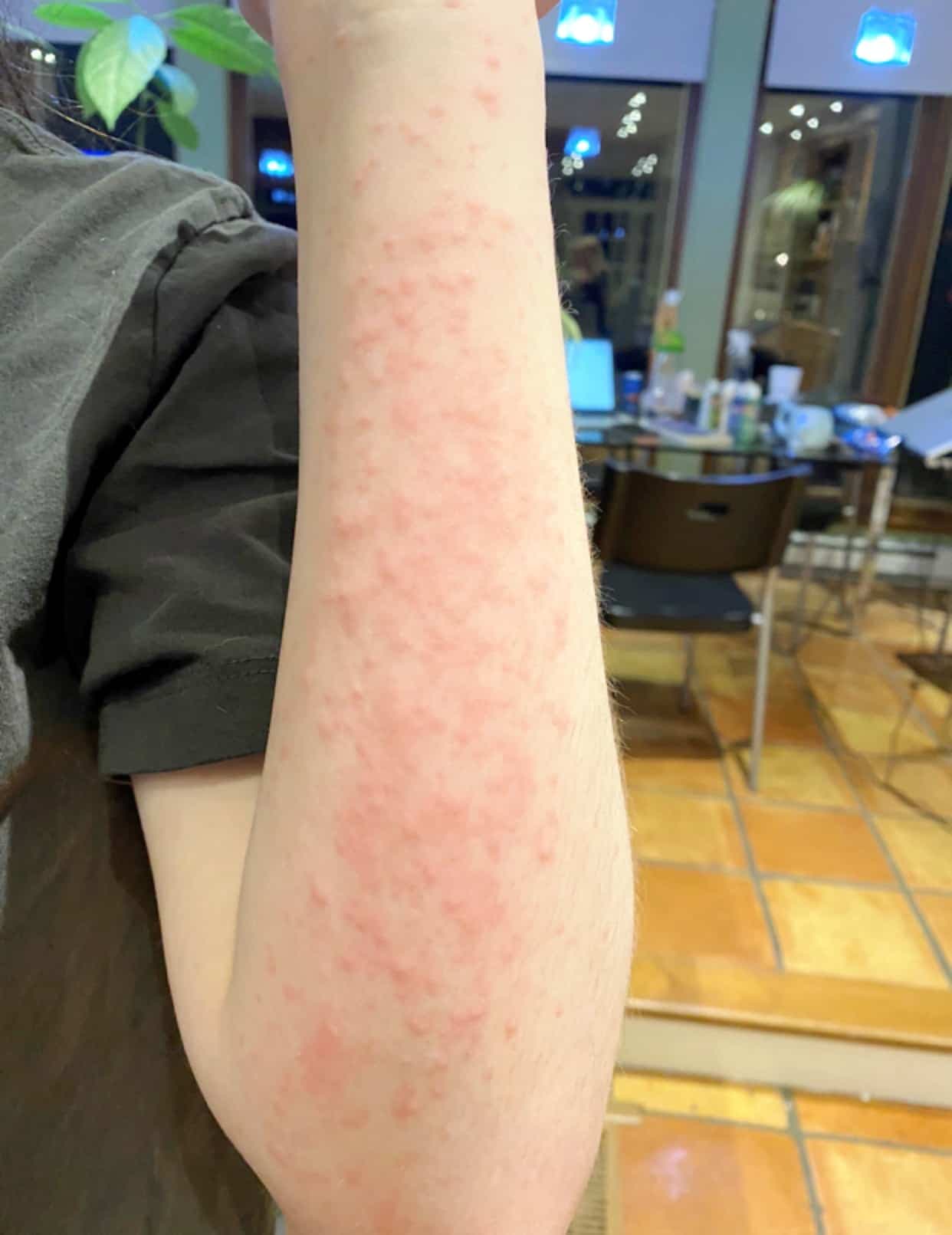 Si Eryn Margolese est en contact avec le froid, sa peau se couvre d’urticaire, comme ici.