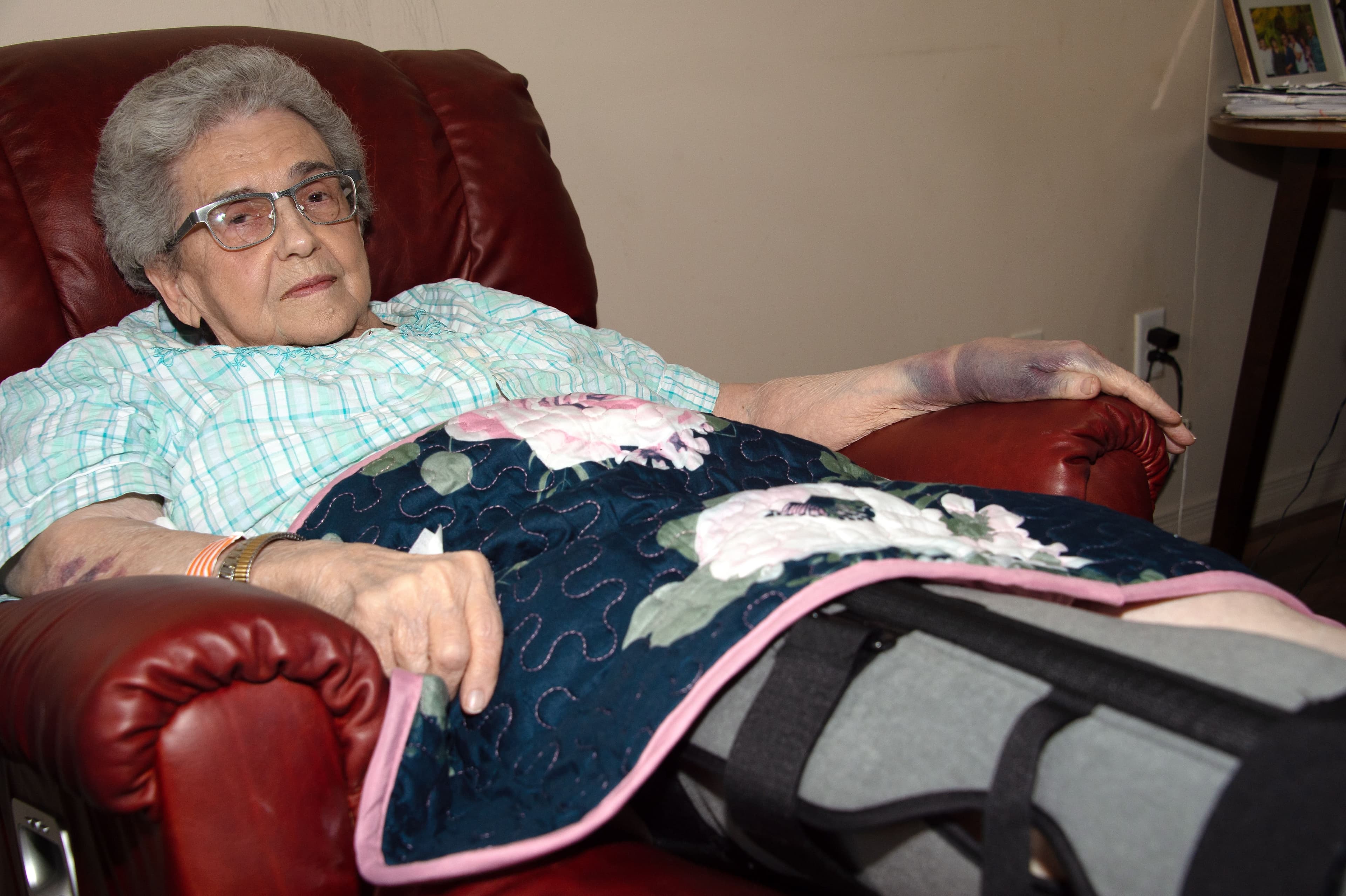 Le poignet gauche de Rosina Ménard Jean, photographiée dans son appartement de Gatineau mardi, a pris une teinte violacée depuis sa chute.