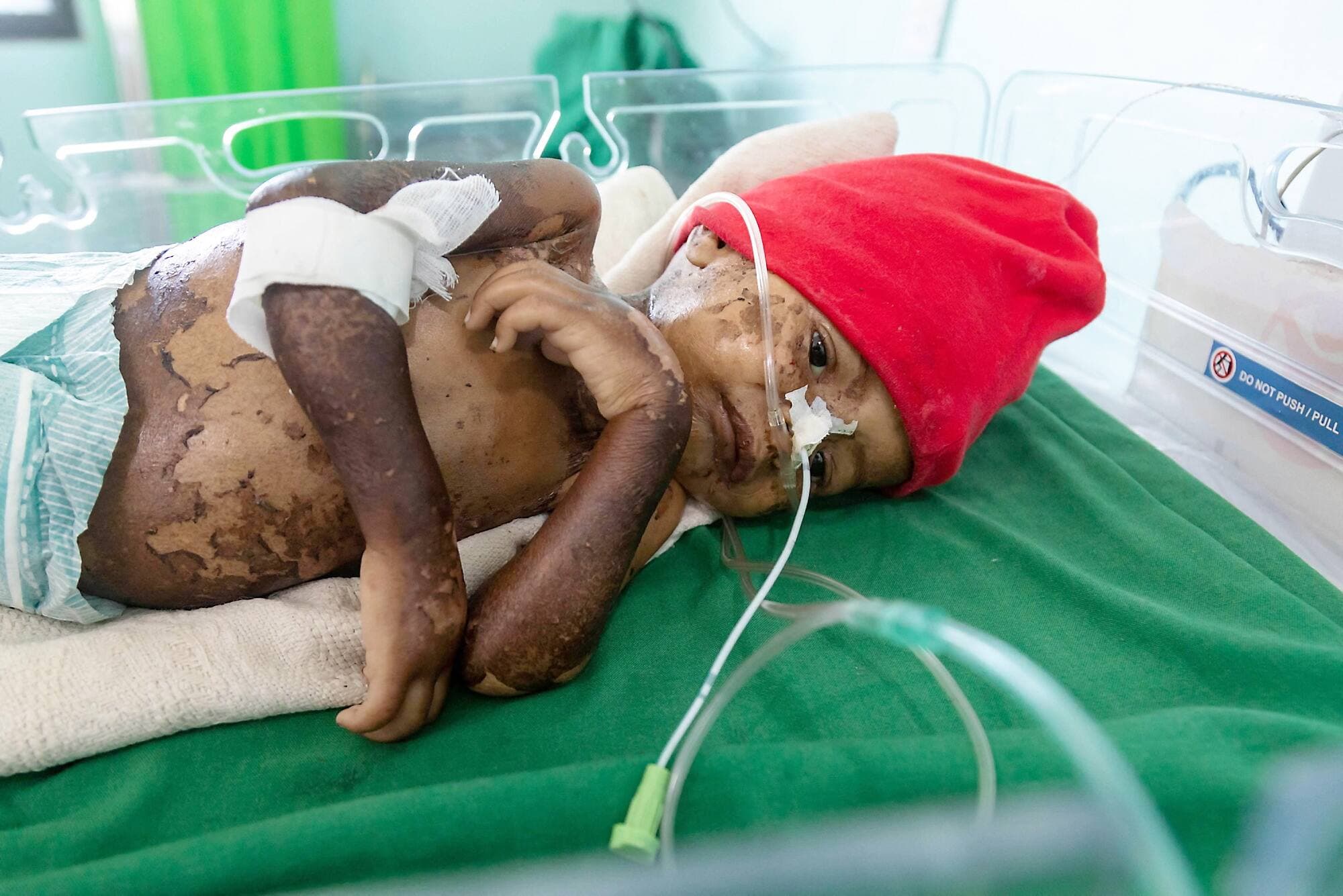 Un enfant du Yémen est hospitalisé pour malnutrition.